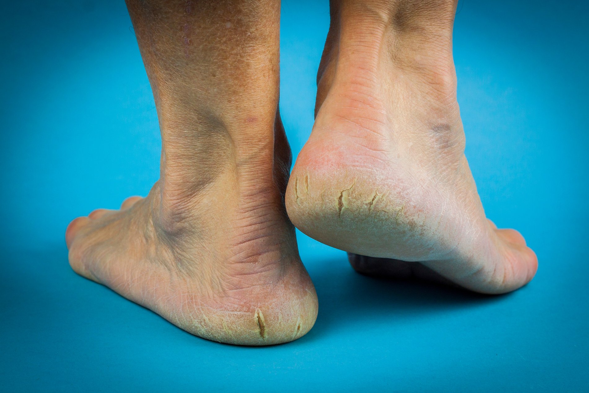 Cracked heels on blue background